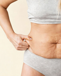 Resultados tras una liposucci&oacute;n