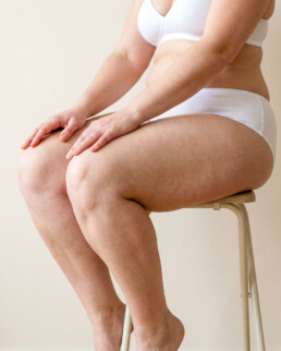 Tratamientos para lipedema