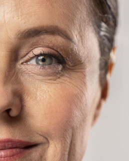 Tratamiento de &Aacute;cido Hialur&oacute;nico en Marbella