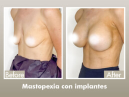 antes y despu&eacute;s de mastopexia con implantes