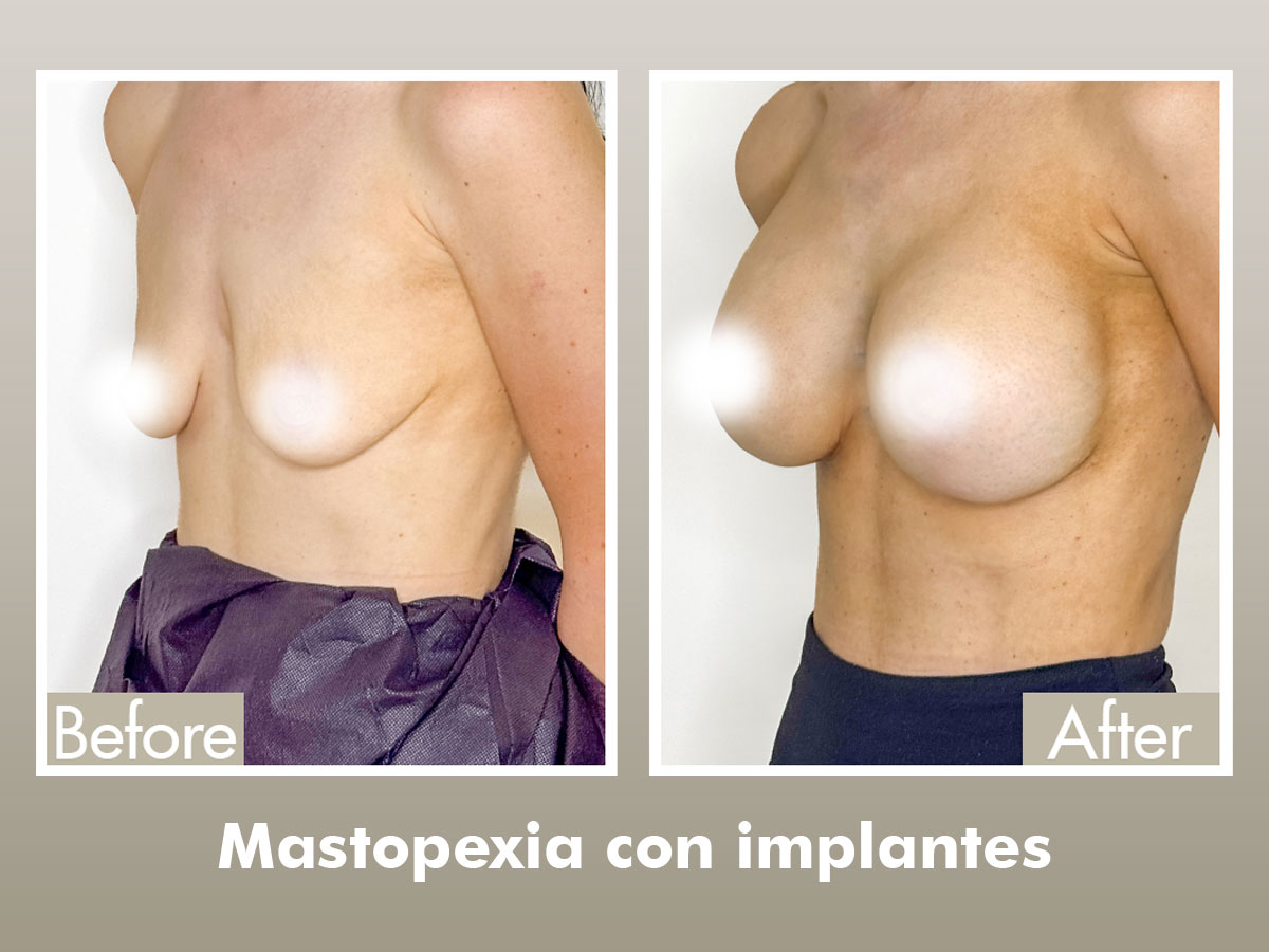 antes y después de mastopexia con implantes
