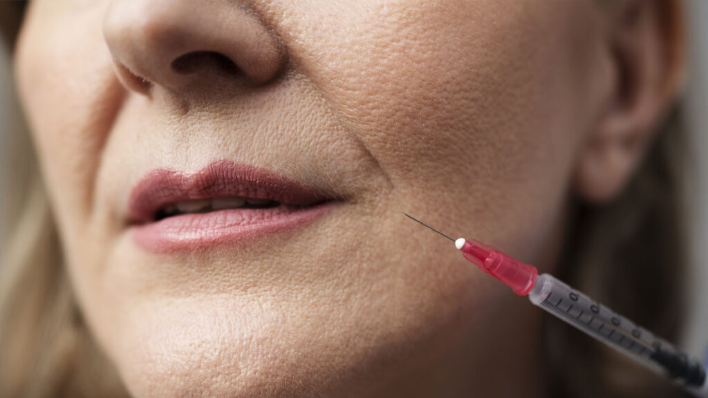 Ácido hialurónico para tratamiento de labios